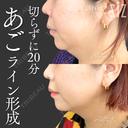 【切らずに20分】あごライン形成 after画像 サムネイル用