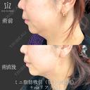 【切らずに20分】あごライン形成 before画像 サムネイル用