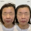 額ヒアルロン酸 before画像 サムネイル用
