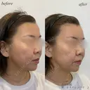 額ヒアルロン酸 after画像 サムネイル用