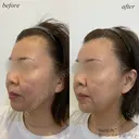 額ヒアルロン酸 after画像 サムネイル用