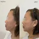額ヒアルロン酸 after画像 サムネイル用