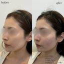 頬コケ　ほうれい線ヒアルロン酸 after画像 サムネイル用