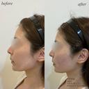 頬コケ　ほうれい線ヒアルロン酸 after画像 サムネイル用