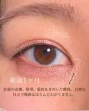 目頭切開 30日後 サムネイル用