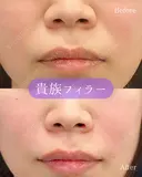 貴族フィラー(ボラックス) before画像 サムネイル用