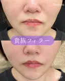 貴族フィラー(ボラックス) 0日後 サムネイル用