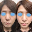 【女性】 蘇原しのぶ院長オリジナル鼻ヒアルロン酸 before画像 サムネイル用