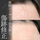【傷跡修正】他院レーザーで効果なし after画像 サムネイル用