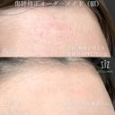 【傷跡修正】他院レーザーで効果なし before画像 サムネイル用