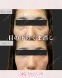 目の下のくぼみ、クマ改善✨ ヒアルロン酸注入で“疲れて見える目元”をパッと明るく✨ after画像 サムネイル用