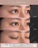 二重術（埋没法）（J式）自然癒着法6点留め before画像 サムネイル用