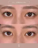 二重術（埋没法）（J式）自然癒着法6点留め after画像 サムネイル用