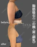 脂肪吸引(二の腕・肩・付け根・副乳・脇肉) before画像 サムネイル用