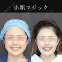 小顔マジック before画像 サムネイル用