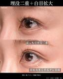 埋没二重＋下眼瞼下制術(糸) after画像 サムネイル用