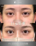 タレ目形成×目尻切開 before画像 サムネイル用