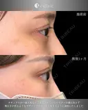 タレ目形成×目尻切開 30日後 サムネイル用