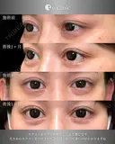 タレ目形成×目尻切開 30日後 サムネイル用
