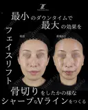 フェイスリスト５０万〜 before画像 サムネイル用