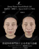 フェイスリスト５０万〜 after画像 サムネイル用
