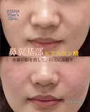 鼻翼基部ヒアルロン酸	 before画像 サムネイル用