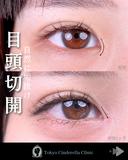 MD式目頭切開 30日後 サムネイル用