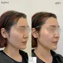 鼻翼基部　ほうれい線ヒアルロン酸 after画像 サムネイル用