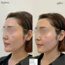 鼻翼基部　ほうれい線ヒアルロン酸 after画像 サムネイル用