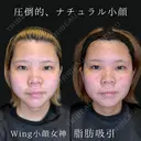 Wing小顔女神脂肪吸引 30日後 サムネイル用