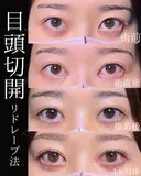 目頭切開 30日後 サムネイル用