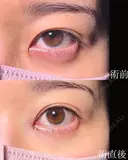 目頭切開 before画像 サムネイル用