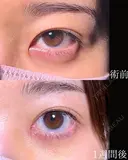目頭切開 7日後 サムネイル用