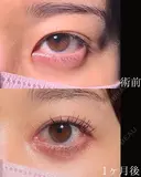 目頭切開 30日後 サムネイル用