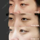 経結膜脱脂術＋眼窩脂肪注入 before画像 サムネイル用