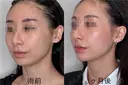 ミニリフト before画像 サムネイル用