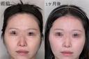 額リフト before画像 サムネイル用