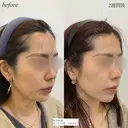 ほうれい線ヒアルロン酸 after画像 サムネイル用