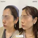 ほうれい線ヒアルロン酸 after画像 サムネイル用