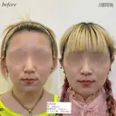 カスタマイズヒアルロン酸 before画像 サムネイル用
