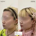 カスタマイズヒアルロン酸 after画像 サムネイル用