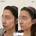 鼻翼基部ほうれい線ヒアルロン酸 after画像 サムネイル用