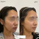 鼻翼基部ほうれい線ヒアルロン酸 after画像 サムネイル用