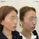 顎ヒアルロン酸　ボトックス after画像 サムネイル用