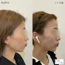 顎ヒアルロン酸　ボトックス after画像 サムネイル用