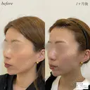 顎ヒアルロン酸　ボトックス after画像 サムネイル用