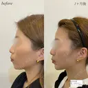 顎ヒアルロン酸　ボトックス after画像 サムネイル用