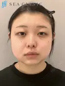 脂肪吸引(頬・顎下)/バッカルファット除去/顎ヒアルロン酸/エラボトックス/二重埋没法 before画像 サムネイル用