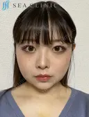 脂肪吸引(頬・顎下)/バッカルファット除去/顎ヒアルロン酸/エラボトックス/二重埋没法 30日後 サムネイル用