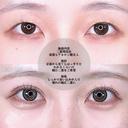 アリエルクイックループトリプル二重埋没法 before画像 サムネイル用